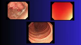 Gastric giant polyp  Todua Clinic [upl. by Eatnahs]