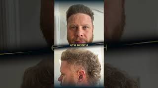 Hair Transplant Before After nowhairtime hairtransplant hairtransplantbeforeafter [upl. by Selrhc]