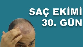 Saç ekimi  Şok dükülme 30 gün [upl. by Elamor]