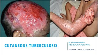 SKINCUTANEOUS TUBERCULOSIS BY DR ABRAHAM TB ulcers funny viralvideo education dermatology [upl. by Darton]