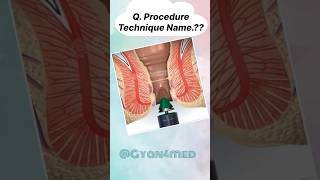 Procedure technique name [upl. by Eeram]