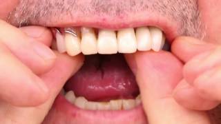 Partial Denture Video [upl. by Bendicty]