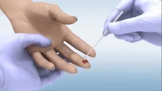 DPP® HIV 12 Assay  Whole Blood Sample [upl. by Terrye]