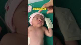 Reflex examination physiology  palmar reflex in newborn  Glabellar reflex in newborn  youtube [upl. by Onidranreb124]