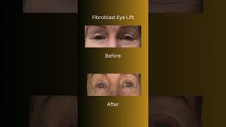 Fibroblast  Eye Lift  fibroblast plasmapen orangecounty [upl. by Dottie]