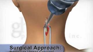 Posterior Upper Cervical Surgical Approach [upl. by Ainez]