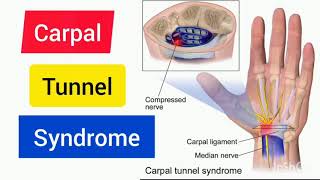 Carpal Tunnel Syndrome  Anatomy  Made Easy  Viva Question [upl. by Mossberg153]