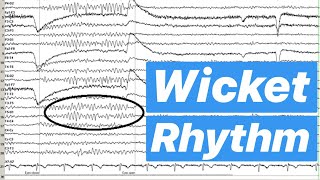 Wicket Rhythm EEG [upl. by Philps682]