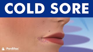 COLD SORES  Causes and symptoms of herpes on lip © 8K [upl. by Aderf57]