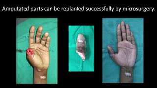 Preservation of amputated part for reattachment surgery [upl. by Doty841]