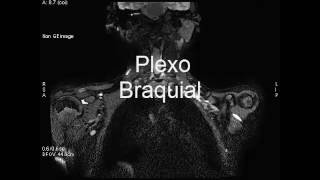 Plexo braquial [upl. by Bethena]