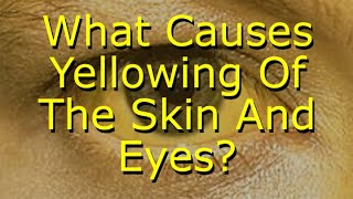 What Causes Yellowing Of The Skin And Eyes [upl. by Lichter]