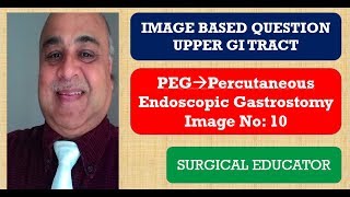 PERCUTANEOUS ENDOSCOPIC GASTROSTOMY UPPER GI TRACT Image Based Question [upl. by Atiuqrahs]