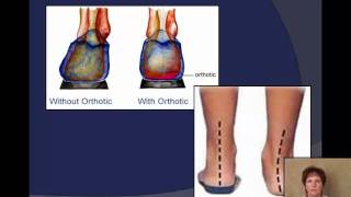 Plantar Fasciitis explained by a Podiatrist [upl. by Andaira641]