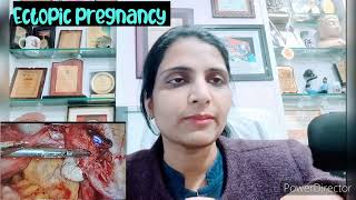 ectopic प्रेगनेंसी क्या होती है इसका क्या इलाज हैectopicpregnancy ectopic laparoscopysurgery [upl. by Geoffrey]