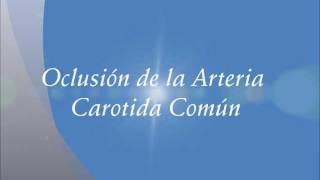 Oclusión de la Arteria Carótida Común Carotid thrombosis [upl. by Klos636]