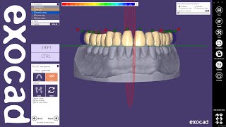 exocad Quick Guide Designing a single arch denture [upl. by Alegnat]