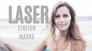 Howto Stretch Mark Removal With Laser Treatment [upl. by Enihpesoj204]