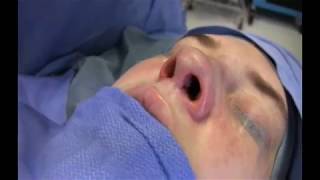 Inserting the Nasal Airway System [upl. by Dilan]