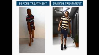 Polio Treatment for Hand Thigh Gait [upl. by Erfert]