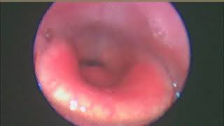 Drug Induced Sleep Endoscopy  rare laryngeal obstruction seen [upl. by Liesa515]