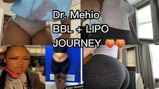 BBL JOURNEY 🍑 DR MEHIO 👨🏻‍⚕️ MIA AESTHETICS MIAMI ✈️ PREOP  POSTOP  BODY REVEAL [upl. by Serene]