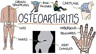 Understanding Osteoarthritis [upl. by Nnaharas753]