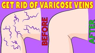 How to get rid of Varicose Veins naturally in 3 minutes a day [upl. by Haskins]