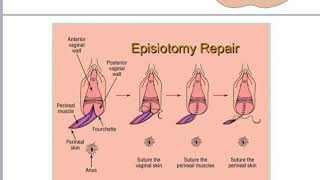 Episiotomy [upl. by Enohs]