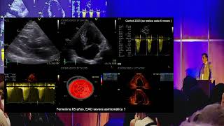 Estenosis Aortica Asintomatica Cuando pienso en Intervenir [upl. by Louise]