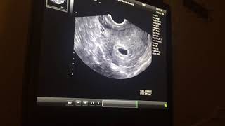 Pregnancy ultrasound 5 weeks and 5 days [upl. by Kabob11]