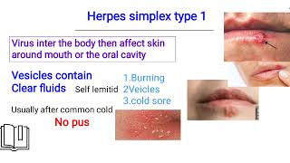 herpes simplex infection الهيربس [upl. by Mehetabel]