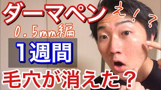 【ダーマペン１週間】初級編！これが事実！05mmの針で肌が綺麗になったのか大公開！ [upl. by Ballard]