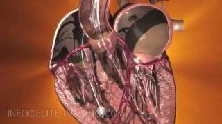 Heart Valve Implantation Full Procedure  Medical amp Scientific Video Production [upl. by Lanfri65]