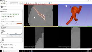 DICOM to STL Conversion Tutorial with Threshold Editor [upl. by Ane]