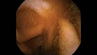 Capsule endoscopy celiacmpg [upl. by Ball]