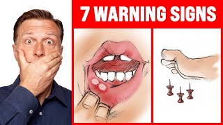 The 7 WARNING Signs of a B12 Deficiency  Dr Berg [upl. by Zrike941]