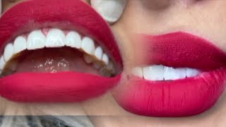 Getting Front Teeth Veneers before and after closeup  procedure [upl. by Nielsen]