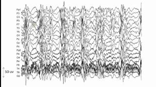 Pharmacologically induced coma Neurophysiology and closedloop control [upl. by Boyse161]