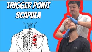 TRIGGER POINT SCAPULA [upl. by Berg]