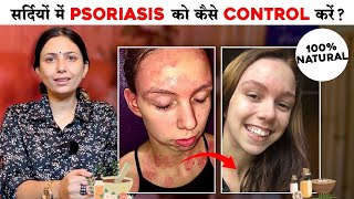 Psoriasis को कैसे Control करें 100 Natural  Psoriasis Treatment  Upasana Ki Duniya [upl. by Robbert]