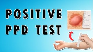 Positive PPD Test [upl. by Amlas]