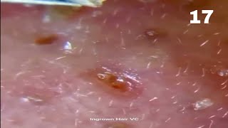 Nose Blackhead Removal Whiteheads On The Nose The Skin Is Dug Very Tightly Clip 17 [upl. by Eirameinna983]