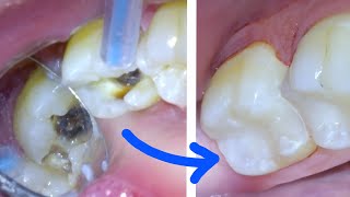 🦷 How a CAVITY amp TOOTH FILLING Procedure Are Done Right by A Dentist White Resin Composite Class 2 [upl. by Harrell]