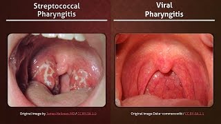 Streptococcal vs Viral Pharyngitis [upl. by Anisirhc692]