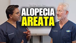 Alopecia Areata An InDepth Discussion [upl. by Sitoiyanap]