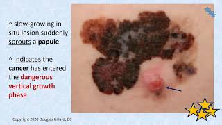 Malignant Melanoma The Most Deadly Form of Skin Cancer Primary Health Care Providers Cant Miss It [upl. by Turnheim480]