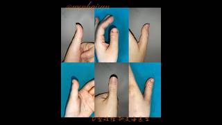 Brachydactyly Type D distraction lengthening brachydactyly doctor thumb meganfox [upl. by Skelton44]