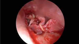 Endoscopic tympanoplasty with Cartilage ossiculoplasty [upl. by Cressy772]