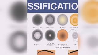 Classification of Cataract amp Senile Cataract  Cataract  PART2 [upl. by Dennie]